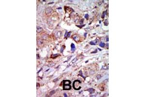Formalin-fixed and paraffin-embedded human cancer tissue reacted with MAP3K12 polyclonal antibody  , which was peroxidase-conjugated to the secondary antibody, followed by AEC staining.