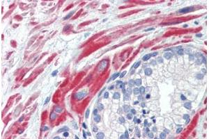 Human Prostate (formalin-fixed, paraffin-embedded) stained with SSX4 antibody ABIN462200 followed by biotinylated goat anti-rabbit IgG secondary antibody ABIN481713, alkaline phosphatase-streptavidin and chromogen. (SSX4 anticorps  (AA 108-157))