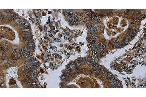 Immunohistochemistry of paraffin-embedded Human colon cancer using GLUL Polyclonal Antibody at dilution of 1:60 (GLUL anticorps)
