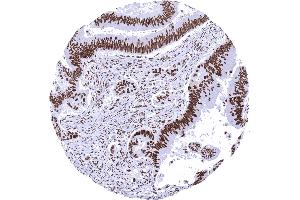 Colon Colorectal adenocarcinoma with strong MSH2 immunostaining in cancer cells and in stromal cells