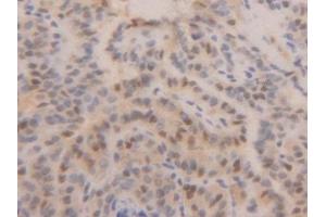 Detection of PCNA in Human Thyroid cancer Tissue using Polyclonal Antibody to Proliferating Cell Nuclear Antigen (PCNA) (PCNA anticorps  (AA 6-261))