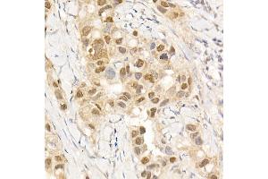 Immunohistochemistry of paraffin-embedded human breast cancer using c-Abl Rabbit pAb (ABIN3020871, ABIN3020872, ABIN3020873 and ABIN6213767) at dilution of 1:25 (40x lens).