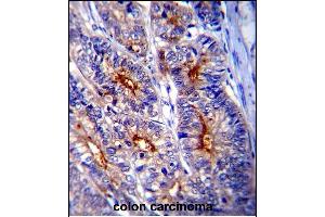 LGALS3 Antibody (C-term) (ABIN1536595 and ABIN2843799) immunohistochemistry analysis in formalin fixed and paraffin embedded human colon carcinoma followed by peroxidase conjμgation of the secondary antibody and DAB staining.