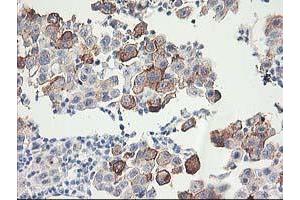 Immunohistochemical staining of paraffin-embedded Carcinoma of Human lung tissue using anti-FAM119A mouse monoclonal antibody. (FAM119A anticorps)