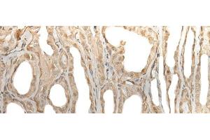 Immunohistochemistry of paraffin-embedded Human thyroid cancer tissue using ZBTB18 Polyclonal Antibody at dilution of 1:50(x200) (ZNF238 anticorps)