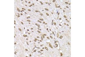 Immunohistochemistry of paraffin-embedded human colon carcinoma using LMNB2 Antibody (ABIN5973877) at dilution of 1/200 (40x lens). (Lamin B2 anticorps)