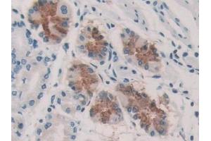 Detection of KARS in Human Stomach cancer Tissue using Polyclonal Antibody to Lysyl tRNA Synthetase (KARS) (KARS anticorps  (AA 323-553))