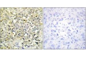 Immunohistochemistry analysis of paraffin-embedded human lung carcinoma tissue, using CDKL4 Antibody. (CDKL4 anticorps  (AA 266-315))