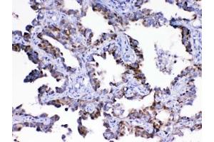 IHC testing of FFPE human lung cancer tissue with ASL antibody at 1ug/ml.