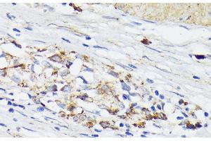 Immunohistochemistry of paraffin-embedded Human gastric cancer using TREM2 Polyclonal Antibody at dilution of 1:200 (40x lens). (TREM2 anticorps)