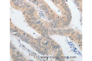 Immunohistochemistry of Human colon cancer using PPAP2A Polyclonal Antibody at dilution of 1:40