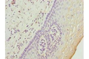 Immunohistochemistry of paraffin-embedded human cervical cancer using ABIN7174639 at dilution of 1:100 (UGT2B10 anticorps  (AA 20-280))