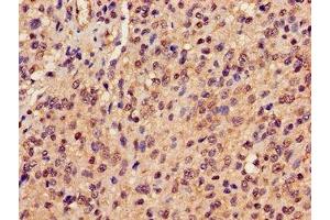 Immunohistochemistry of paraffin-embedded human glioma using ABIN7162945 at dilution of 1:100