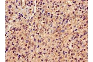 Immunohistochemistry of paraffin-embedded human glioma using ABIN7162945 at dilution of 1:100 (Peroxiredoxin 6 anticorps  (AA 87-224))