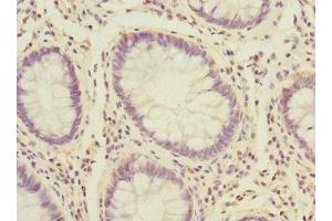 Immunohistochemistry of paraffin-embedded human colon cancer using ABIN7164721 at dilution of 1:100 (PROK2 anticorps  (AA 20-129))