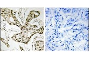 Immunohistochemistry analysis of paraffin-embedded human liver carcinoma tissue, using TOP2A Antibody.