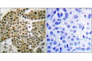 Immunohistochemistry analysis of paraffin-embedded human breast carcinoma tissue, using NF-kappaB p105/p50 (Ab-927) Antibody. (NFKB1 anticorps  (AA 896-945))