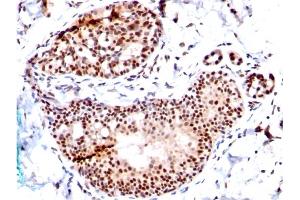 Formalin-fixed, paraffin-embedded human Breast Carcinoma stained with SUMO-1 Mouse Monoclonal Antibody (SM1/495) (SUMO1 anticorps)