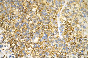 Immunohistochemistry was performed on paraffin-embedded human glioblastoma using creatine kinase B antibody (ABIN7798163), 1:200). (Recombinant CKB anticorps)