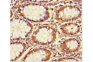 Immunohistochemistry of paraffin-embedded human colon cancer using ABIN7172166 at dilution of 1:100 (CCDC59 anticorps  (AA 1-241))