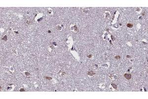 ABIN6268712 at 1/100 staining Human brain cancer tissue by IHC-P. (Aquaporin 4 anticorps  (Internal Region))
