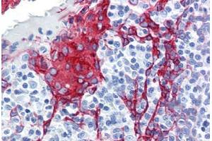 Human Tonsil (formalin-fixed, paraffin-embedded) stained with KRT13 antibody ABIN364278 at 10 ug/ml followed by biotinylated anti-mouse IgG secondary antibody ABIN481714, alkaline phosphatase-streptavidin and chromogen. (Cytokeratin 13 anticorps)