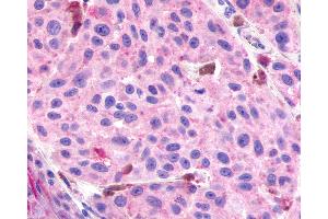 Anti-RXFP3 antibody IHC of human Skin, Melanoma.