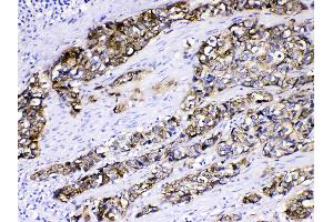 Cytokeratin 5 was detected in paraffin-embedded sections of human oesophagus squama cancer tissues using rabbit anti- Cytokeratin 5 Antigen Affinity purified polyclonal antibody (Catalog # ) at 1 µg/mL. (Cytokeratin 5 anticorps  (Middle Region))