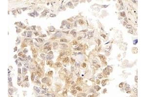 Detection of GAL3 in Human Lung cancer Tissue using Polyclonal Antibody to Galectin 3 (GAL3)
