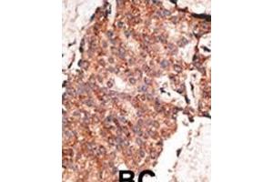 Formalin-fixed and paraffin-embedded human cancer tissue reacted with the primary antibody, which was peroxidase-conjugated to the secondary antibody, followed by AEC staining. (BMP1 anticorps  (C-Term))
