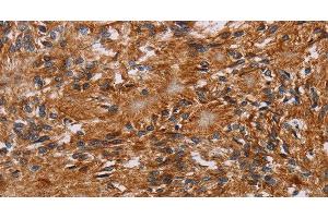 Immunohistochemistry of paraffin-embedded Human ovarian cancer tissue using JAKMIP2 Polyclonal Antibody at dilution 1:40 (JAKMIP2 anticorps)