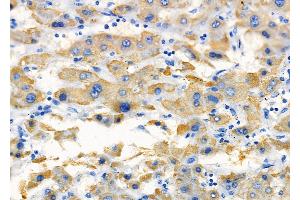 ABIN6257437 and ABIN6275374 at 1/100 staining Human liver cancer by IHC-P. (KCNK4 anticorps  (C-Term))