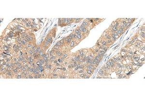 Immunohistochemistry of paraffin-embedded Human gastric cancer tissue using CA7 Polyclonal Antibody at dilution of 1:50(x200) (CA7 anticorps)