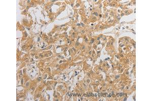 Immunohistochemistry of Human ovarian cancer using HCRTR2 Polyclonal Antibody at dilution of 1:50 (HCRTR2 anticorps)