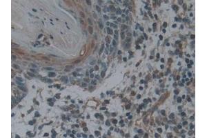 Detection of LTbR in Human Skin cancer Tissue using Polyclonal Antibody to Lymphotoxin Beta Receptor (LTbR)