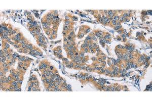 Immunohistochemistry of paraffin-embedded Human breast cancer tissue using CAMK4 Polyclonal Antibody at dilution 1:40 (CAMK4 anticorps)