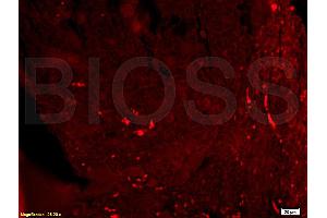 Formalin-fixed and paraffin-embedded human rectal carcinoma labeled with Rabbit Anti-EpCAM Polyclonal Antibody (ABIN687592), Unconjugated 1:200 followed by conjugation to the secondary antibody and DAB staining (EpCAM anticorps  (AA 221-314))