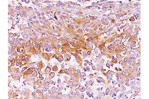Formalin-fixed, paraffin-embedded human melanoma stained with gp100 / Melanosome Mouse Monoclonal Antibody (NKI-beteb). (Melanoma gp100 anticorps)