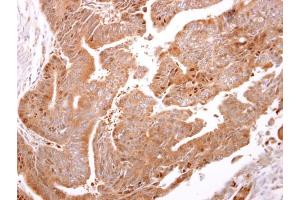 IHC-P Image ARF3 antibody detects ARF3 protein at cytosol on human colon carcinoma by immunohistochemical analysis.
