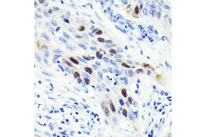 Immunohistochemistry of paraffin-embedded human lung cancer using Cyclin  Rabbit mAb (ABIN7266551) at dilution of 1:100 (40x lens). (Cyclin A anticorps)