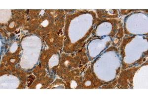 Immunohistochemistry of paraffin-embedded Human thyroid cancer using RAB27A Polyclonal Antibody at dilution of 1:30 (RAB27A anticorps)