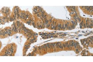 Immunohistochemistry of paraffin-embedded Human colon cancer tissue using PIK3R3 Polyclonal Antibody at dilution 1:45 (PIK3R3 anticorps)