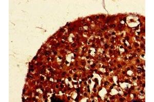 Immunohistochemistry of paraffin-embedded human breast cancer using ABIN7154360 at dilution of 1:100