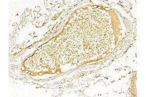ABIN6256503 and ABIN6267060 at 1/100 staining Human normal tissues adjacent to colorectal cancer by IHC-P. (ERK1 anticorps  (pThr202, pTyr204))