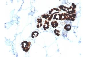 Formalin-fixed, paraffin-embedded human Basal Cell Carcinoma stained with Cytokeratin 15 Mouse Monoclonal Antibody (KRT15/2554).