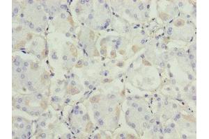 Immunohistochemistry of paraffin-embedded human gastric cancer using ABIN7143652 at dilution of 1:100