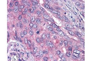Anti-PLK1 antibody IHC of human lung carcinoma. (PLK1 anticorps  (pThr210))