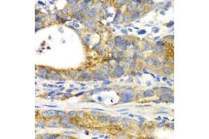 Immunohistochemistry of paraffin-embedded human gastric cancer using GORASP1 antibody. (GORASP1 anticorps  (AA 221-440))