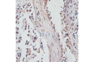 Immunohistochemistry of paraffin-embedded human lung cancer using NCO antibody  at dilution of 1:100 (40x lens). (NCOA4 anticorps  (AA 495-614))