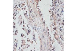 Immunohistochemistry of paraffin-embedded human lung cancer using NCO antibody  at dilution of 1:100 (40x lens). (NCOA4 anticorps  (AA 495-614))